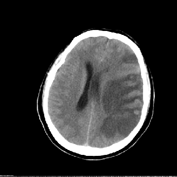 无创颅内压检测在1例脑栓塞患者脑疝早期的诊断作用